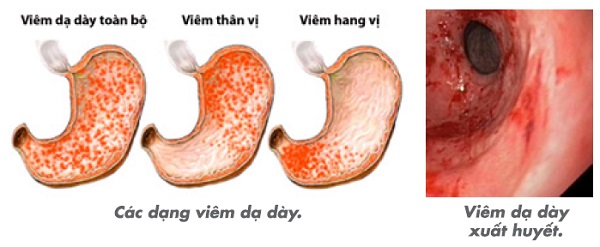 hinh anh viem hầm vi domain authority day