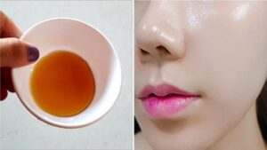 tri tham mun bang mat ong