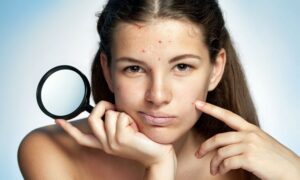 cham soc da sau khi nan mun