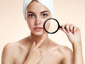 8 cách làm mặt nạ trị mụn trắng da tại nhà