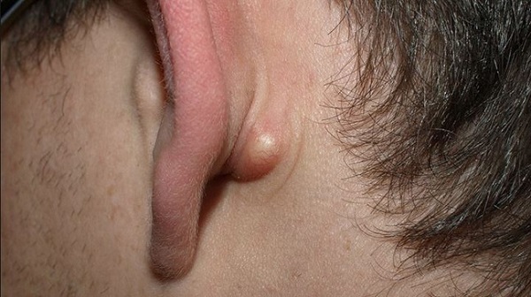 Mụn ở tai là bệnh gì?