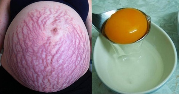 Cách chữa rạn da đỏ bằng lòng trắng trứng