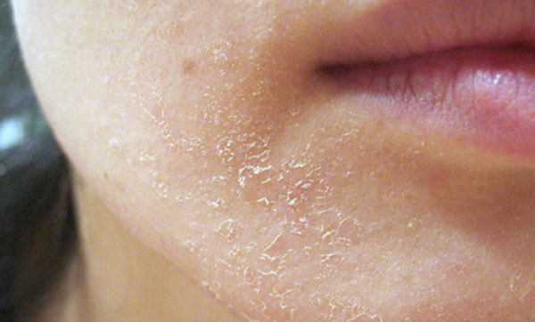 9 biện pháp giúp thoát khỏi làn da bong tróc trên khuôn mặt - da kho bong troc